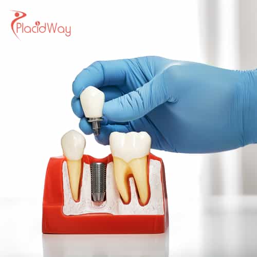 The New Dental Hub: Why UAE Residents Are Flocking to Georgia for Premium Dental Implants